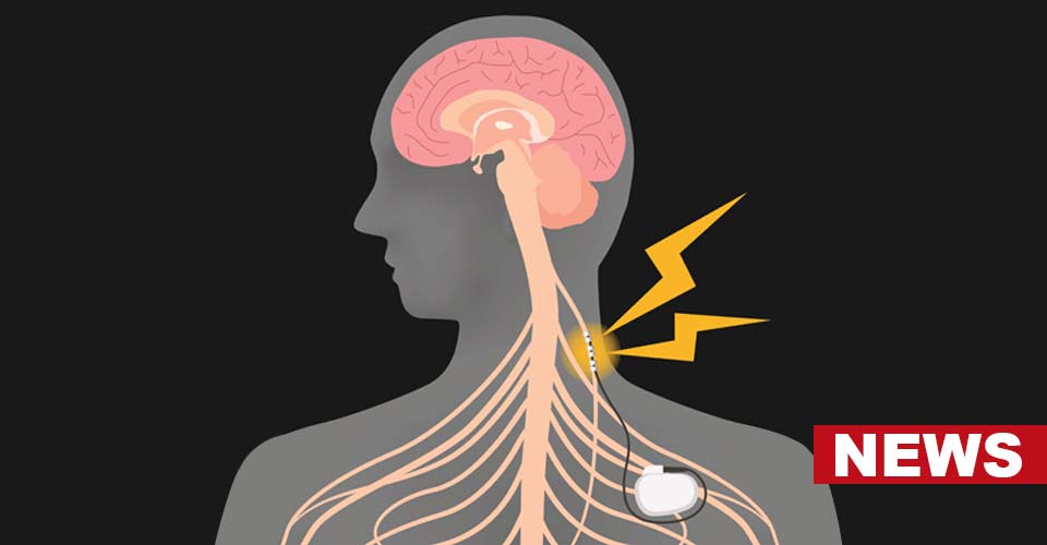 Vagus Nerve Stimulation Helps You Deal With Tense Situations