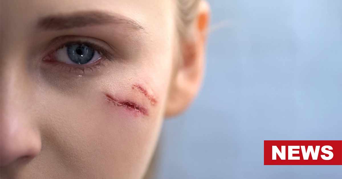 Research Reveals The Mental Health Effects Of Facial Scars