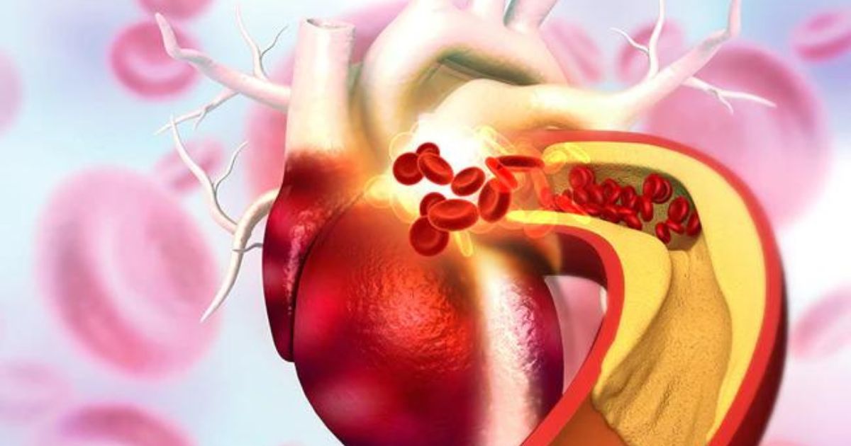 Unveiling The Link: How Stress Impacts Cholesterol Levels And Heart Health