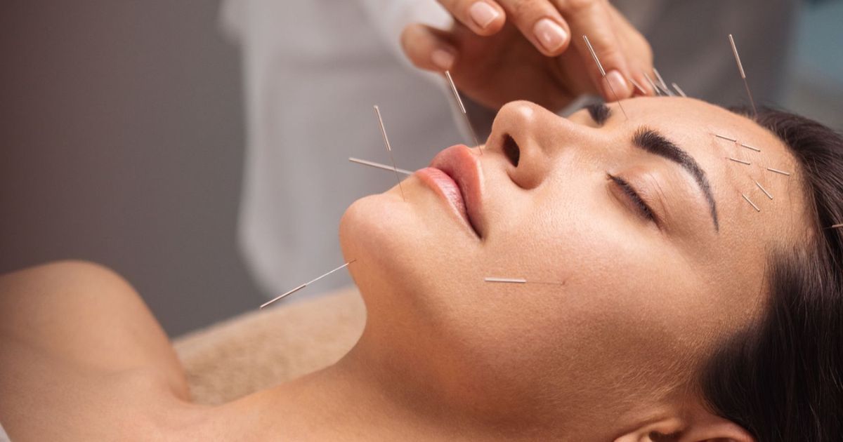 Ancient Practice of Acupuncture Gains Modern Recognition for Alleviating Anxiety